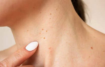 Rahasia Kulit Bersih: Mengapa Detoksifikasi Internal Adalah Kunci Menghilangkan Papiloma